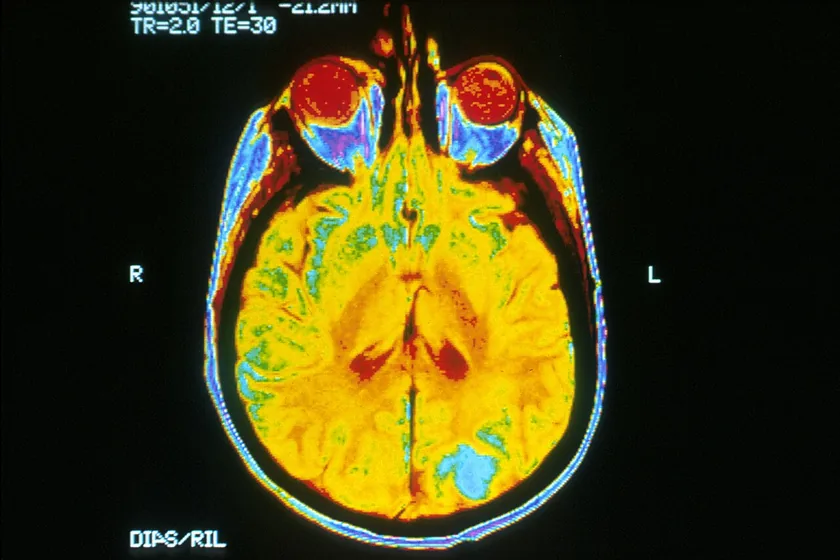 An MRI slice of a human brain, shown in blue and purple tones